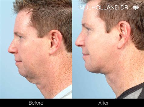 Double Chin Surgery For Men | Toronto Plastic Surgeons