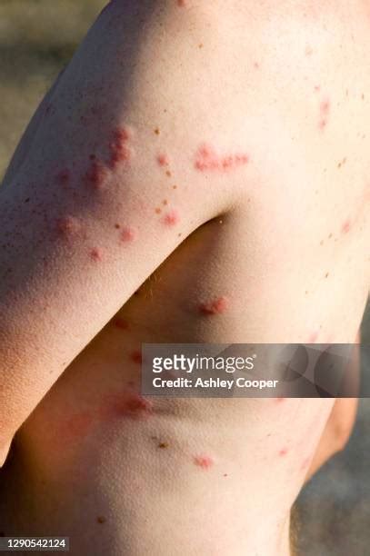 Midge Bites Photos and Premium High Res Pictures - Getty Images