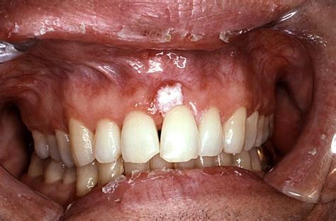 Mouth Cancer - Symptoms, Causes, Stages, Pictures, Treatment, Signs | Diseases Pictures