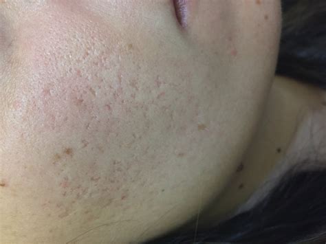 [Skin concerns] Any advice to help reduce the appearance of my post-acne pock marks? I'm tired ...