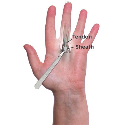 open-surgery-for-trigger-finger Hand Surgery, Post Surgery, Trigger Finger Exercises, Trigger ...