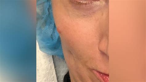 Woman shares warning after mark on face diagnosed as cancerous tumor 2 ...