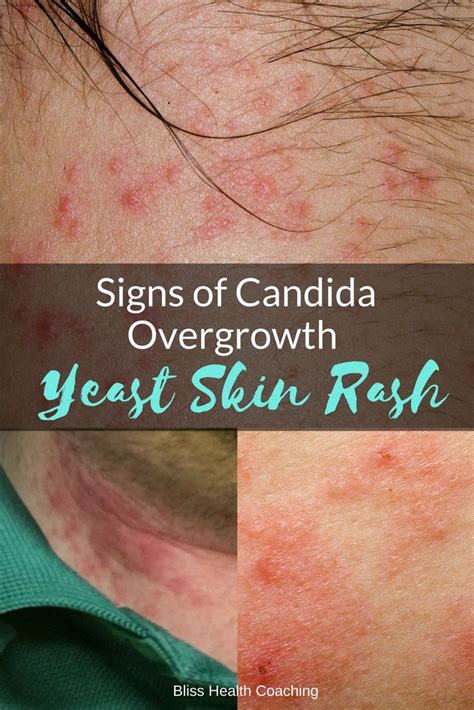 Are you struggling with a yeast rash? Candida overgrowth can cause a painful itchy rash that is ...