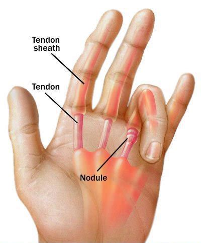 Trigger Finger Treatment in NYC | Hand Pain Doctors New York Specialists