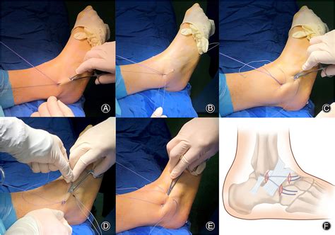 Extensor Retinaculum Foot Injury