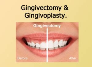 Gingivectomy & Gingivoplasty - Focus Dentistry