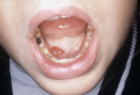 Ranula in a mouth - Stock Image - C023/5739 - Science Photo Library