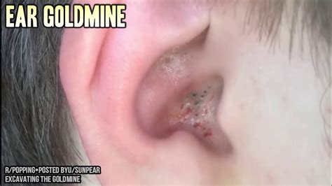 Dr. Popper's Prime Pimple Popping! Colossal Comedones! - YouTube