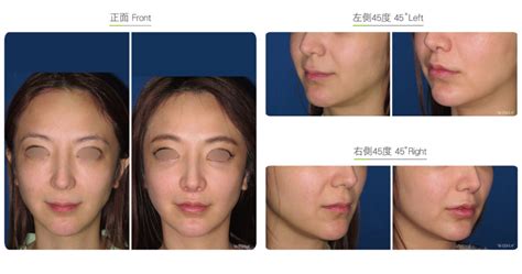 Philtrum Reduction-Facial Surgery | Wish Aesthetic Surgery Clinic