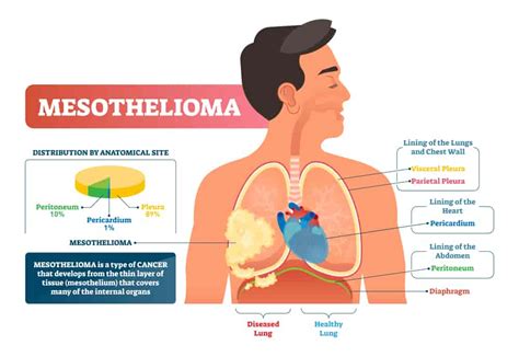 Mesothelioma causes, symptoms, diagnosis, treatment, and life ...