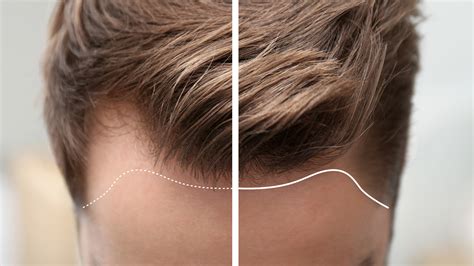 Get Topical Finasteride In UK: Where And How?, 55% OFF