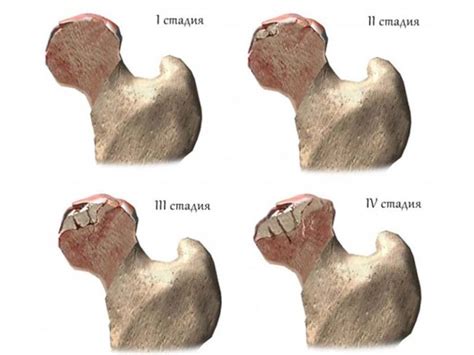 Ischemic Necrosis Of Femoral Head