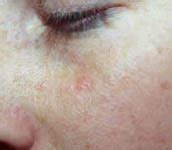 Basal Cell Carcinoma Early Stages Face