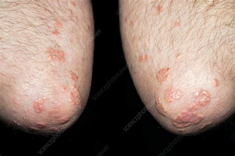 Xanthoma on the elbows - Stock Image - C011/0349 - Science Photo Library