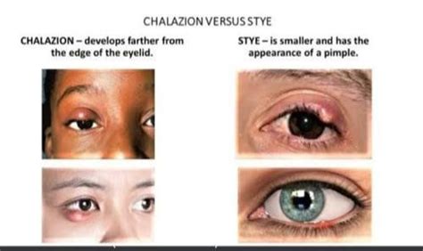 Eye Stye and Chalazion – Cypress Eye Centre