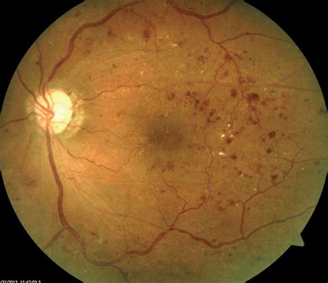 Could Selfie Fundus Imaging Boost Diabetic Retinopathy Screening?