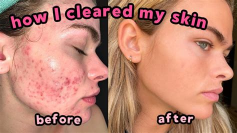 My Accutane Experience & How I Cleared My Severe Acne + Q&A (with lots ...