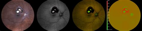 New diagnostic option for rare eye disease