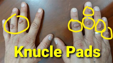 Idiopathic Knuckle Pads - YouTube