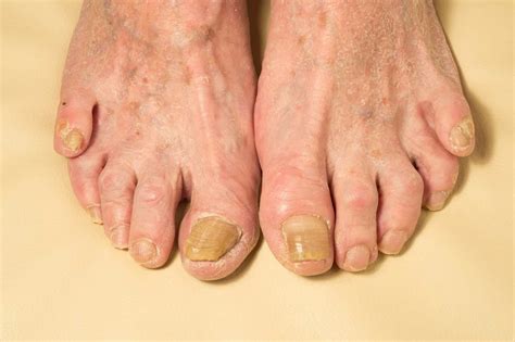 The Science Behind a Fungal Toenail Infection