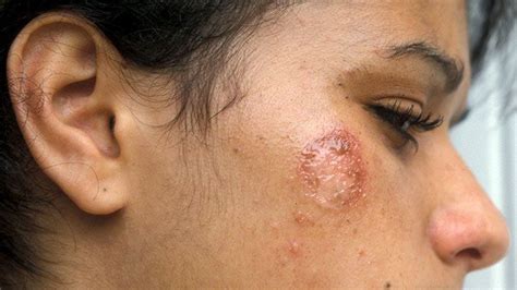 What Causes Impetigo In Dogs