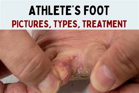 Athlete’s Foot: Pictures, Types, Symptoms, Causes & Treatment