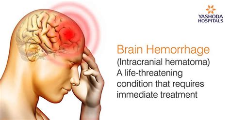 Brain Hemorrhage: Causes and Treatment