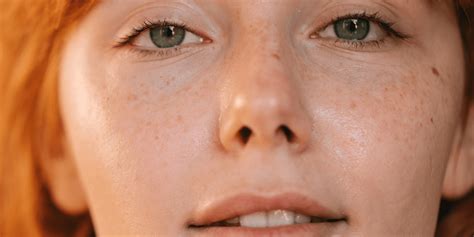 9 Ways to Prevent Broken Capillaries According to Dermatologists