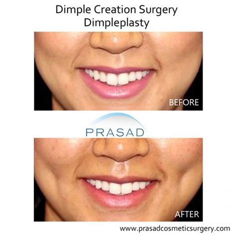 Dimple surgery | Dimple Creation | Learn More - New York