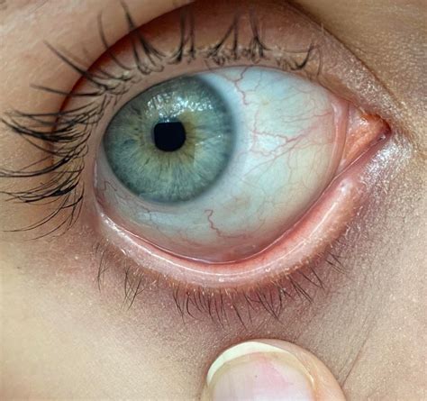 What causes discolored eye whites? : optometry
