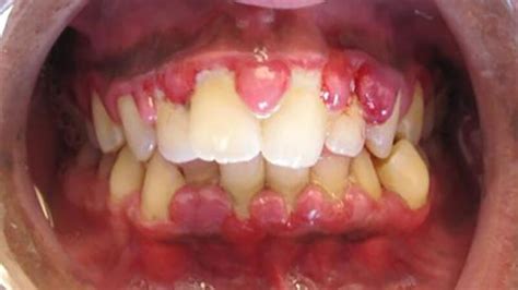 Gingival Hyperplasia: Causes, Treatment, Outlook, and More