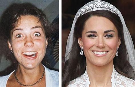 Kate Middleton Nose Job Before | Célébrité chirurgie plastique ...