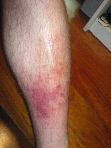 Cellulitis - wikidoc