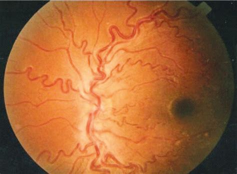 SciELO - Brasil - Sickle cell retinopathy: characterization among ...