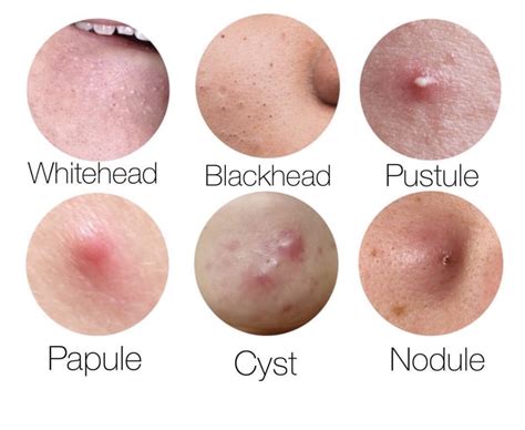 What Type of Acne Do You Have? — YONKERS SPA | Skin and Brow Services