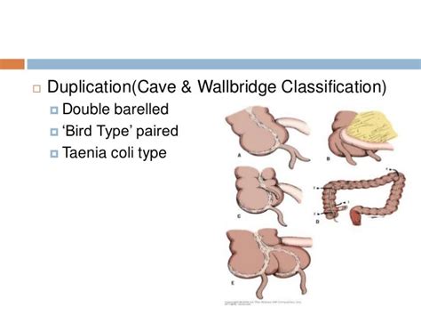 Operative steps in open appendicectomy