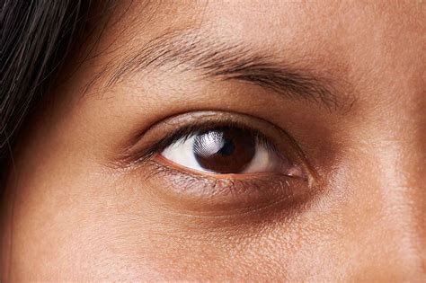 What Causes Dark Circles Around The Eyes