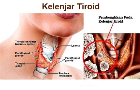 Cara Mengobati Kelenjar Tiroid Bengkak Dan Sakit | AHLINYA PENGOBATAN ALAMI