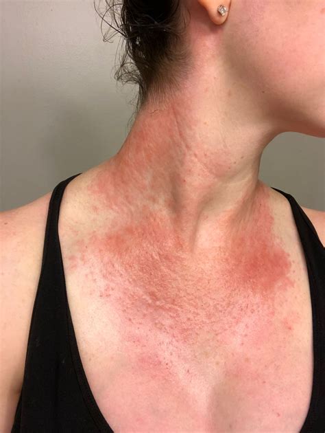 Crazy rash- pregnancy eczema? - November 2019 Babies | Forums | What to Expect