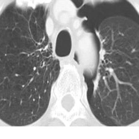 A follow-up CT scan showing a left pneumothorax, which developed... | Download Scientific Diagram