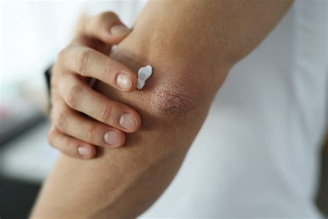 What Should I Do if Topical Steroids Aren’t Controlling My Eczema?