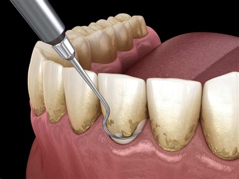 How can you get rid of Dental Plaque? - Royal Dental Clinics Blog