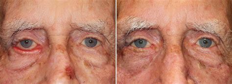 Right lower lid ectropion repair - Blepharoplasty & Eyelid Surgery | Dr. Stout Pasadena, CA