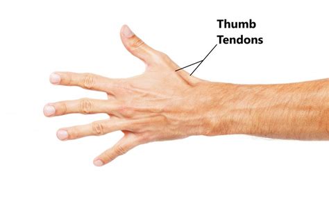 Tendinitis De Quervain Ultrasound