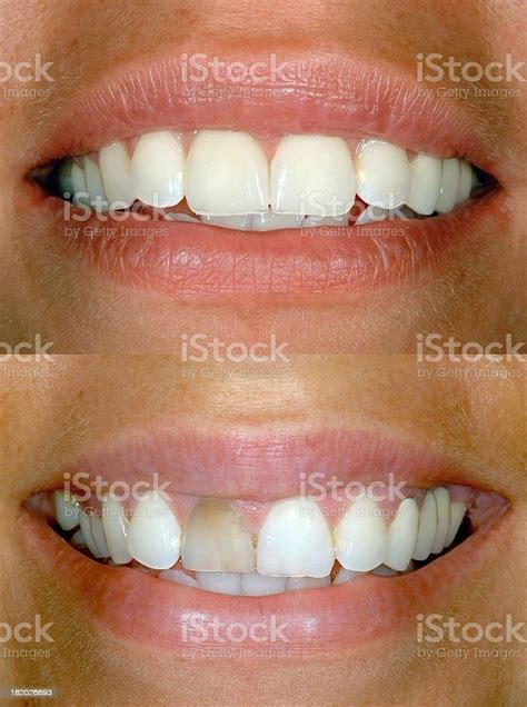 Before After Smile Design Stock Photo - Download Image Now - Dental ...