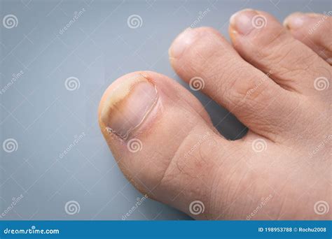 Onychomycosis, The Initial Stage Of Ringworm. Big Toe Infected With Fungal Bacteria, Background ...