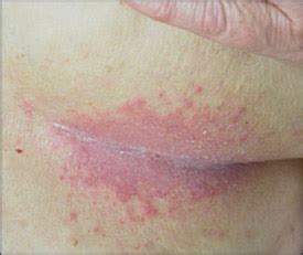 Giro de vuelta Virus Estereotipo candida groin rash esquina Estadístico ...