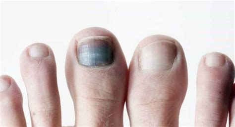 A Black Spot Under The Toenail: What Is It? - Feet First Clinic