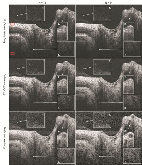 In vivo imaging of a human optic nerve head. A total of 10 000 A-scans... | Download Scientific ...