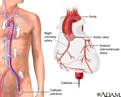 Coronary Angiography/Cardiac Catheterization - The Cardiac Institute